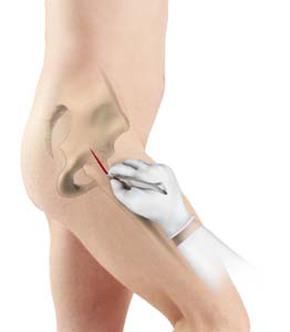 https://www.nicktingmd.com/3d-images/minimally-invasive-total-hip-replacement.jpg